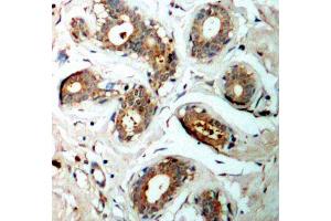Immunohistochemistry of paraffin-embedded human breast carcinoma using Phospho-YWHAZ-S58 antibody (ABIN2987575). (14-3-3 zeta Antikörper  (pSer58))