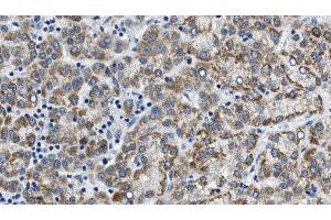 ABIN6274605 at 1/100 staining Human liver cancer tissue by IHC-P. (Cadherin 8 Antikörper  (Internal Region))