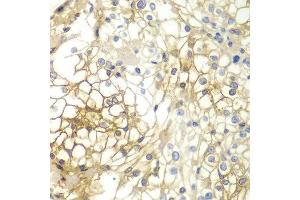 Immunohistochemistry of paraffin-embedded human kidney cancer using SDC1 antibody at dilution of 1:200 (400x lens). (Syndecan 1 Antikörper)
