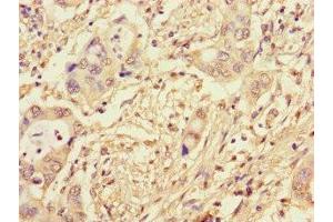 Immunohistochemistry of paraffin-embedded human pancreatic cancer using ABIN7164173 at dilution of 1:100 (CWC22 Antikörper  (AA 360-623))
