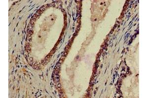 Immunohistochemistry of paraffin-embedded human prostate cancer using ABIN7162439 at dilution of 1:100 (P2RX1 Antikörper  (AA 54-175))