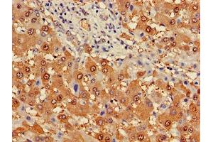Immunohistochemistry of paraffin-embedded human liver cancer using ABIN7163274 at dilution of 1:100 (Phosphoglucomutase 1 Antikörper  (AA 1-562))