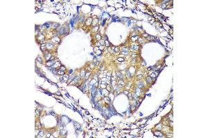 Immunohistochemistry of paraffin-embedded Human colon carcinoma using B Rabbit pAb (ABIN7265675) at dilution of 1:100 (40x lens). (ACTR1B Antikörper  (AA 1-105))