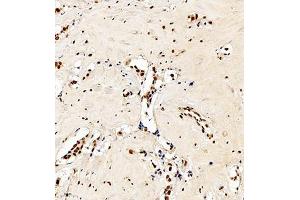 Immunohistochemistry analysis of paraffin embedded human breast cancer using C23 (ABIN7074906) at dilution of 1: 550 (Nucleolin Antikörper)