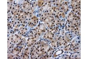 Immunohistochemical staining of paraffin-embedded Carcinoma of liver tissue using anti-LIPG mouse monoclonal antibody. (LIPG Antikörper)