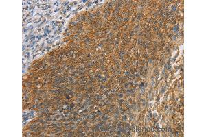 Immunohistochemistry of Human breast cancer using MAPK6 Polyclonal Antibody at dilution of 1:40 (MAPK6 Antikörper)