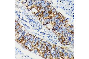 Immunohistochemistry of paraffin-embedded human colon carcinoma using J Rabbit mAb (ABIN7268036) at dilution of 1:100 (40x lens). (JAK1 Antikörper)