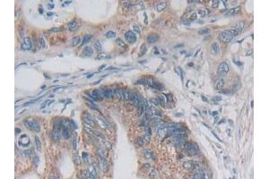 IHC-P analysis of Human Colorectal cancer Tissue, with DAB staining. (Desmoplakin Antikörper  (AA 2609-2822))