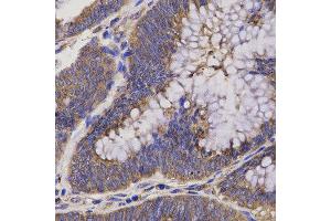 Immunohistochemistry of paraffin-embedded human rectum cancer using EPHX2 antibody at dilution of 1:200 (x40 lens) (EPHX2 Antikörper)