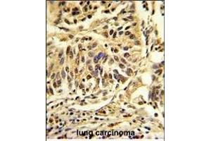 Formalin-fixed and paraffin-embedded human lung carcinoma reacted with CEBPB Antibody (C-term), which was peroxidase-conjugated to the secondary antibody, followed by DAB staining. (CEBPB Antikörper  (C-Term))