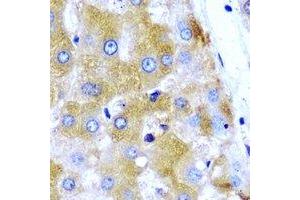 Immunohistochemical analysis of GNT1 staining in human liver cancer formalin fixed paraffin embedded tissue section. (Ugt1 Antikörper)