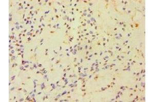 Immunohistochemistry of paraffin-embedded human breast cancer using ABIN7154834 at dilution of 1:100 (HAUS3 Antikörper  (AA 384-603))