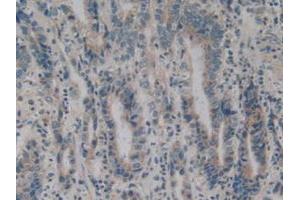 IHC-P analysis of Human Stomach Cancer Tissue, with DAB staining. (BMF Antikörper  (AA 1-181))
