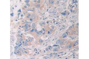 DAB staining on fromalin fixed paraffin- embedded breast cancer tissue)