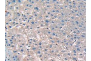 IHC-P analysis of Human Liver Cancer Tissue, with DAB staining. (CD276 Antikörper  (AA 47-219))