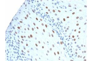 Formalin-fixed, paraffin-embedded human Urothelial Carcinoma stained with p21 Rabbit Recombinant Monoclonal Antibody (CIP1/2275R). (Rekombinanter p21 Antikörper)