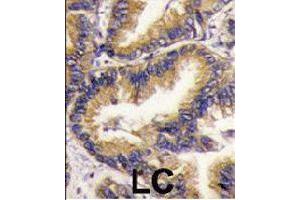 Formalin-fixed and paraffin-embedded human lung carcinoma tissue reacted with URM1 polyclonal antibody  , which was peroxidase-conjugated to the secondary antibody, followed by DAB staining. (Urm1 Antikörper  (N-Term))