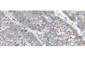 Immunohistochemistry of paraffin-embedded Human liver cancer tissue using XIRP1 Polyclonal Antibody at dilution of 1:90(x200) (XIRP1 Antikörper)