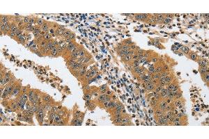Immunohistochemistry of paraffin-embedded Human gastric cancer tissue using PIK3R3 Polyclonal Antibody at dilution 1:45 (PIK3R3 Antikörper)
