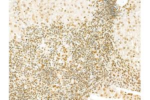 SCXA Antibody at 1/100 staining Human breast cancer by IHC-P. (SCXA Antikörper  (Internal Region))