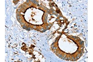 The image on the left is immunohistochemistry of paraffin-embedded Human colon cancer tissue using ABIN7130083(LGALS3BP Antibody) at dilution 1/25, on the right is treated with fusion protein. (LGALS3BP Antikörper)