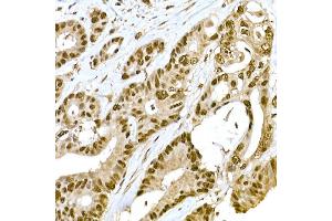 Immunohistochemistry of paraffin-embedded human colon carcinoma using METTL16 Rabbit pAb (ABIN7268501) at dilution of 1:100 (40x lens). (METTL16 Antikörper  (AA 263-562))