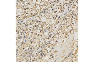 Immunohistochemistry of paraffin-embedded human kidney cancer using PRDX4 antibody at dilution of 1:200 (x400 lens) (Peroxiredoxin 4 Antikörper)