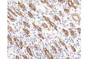 Immunohistochemistry analysis of paraffin-embedded human stomach cancer using CK-7 Monoclonal Antibody at dilution of 1:300. (Cytokeratin 7 Antikörper)