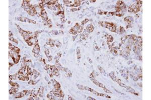 IHC-P Image Immunohistochemical analysis of paraffin-embedded human breast cancer, using IVD, antibody at 1:250 dilution. (IVD Antikörper)
