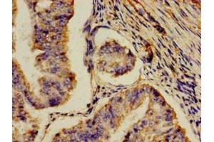 Immunohistochemistry of paraffin-embedded human endometrial cancer using ABIN7159328 at dilution of 1:100 (AOC3 Antikörper  (AA 27-259))
