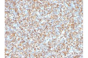 Formalin-fixed, paraffin-embedded human Ewing's Sarcoma stained with Vimentin Mouse Monoclonal Antibody (VM1170). (Vimentin Antikörper)
