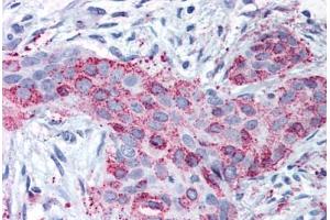 Anti-MMP13 antibody  ABIN1049066 IHC staining of human breast carcinoma. (MMP13 Antikörper  (Internal Region))