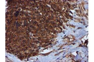 Immunohistochemical staining of paraffin-embedded Adenocarcinoma of Human breast tissue using anti-C1S mouse monoclonal antibody. (C1S Antikörper)
