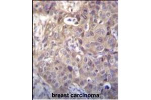 HIPK1 Antibody (C-term) (ABIN656398 and ABIN2845693) immunohistochemistry analysis in formalin fixed and paraffin embedded human breast carcinoma followed by peroxidase conjugation of the secondary antibody and DAB staining. (HIPK1 Antikörper  (C-Term))