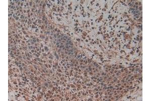 Detection of MCM5 in Human Skin cancer Tissue using Polyclonal Antibody to Minichromosome Maintenance Deficient 5 (MCM5) (Minichromosome Maintenance Deficient 5 (AA 331-537) Antikörper)