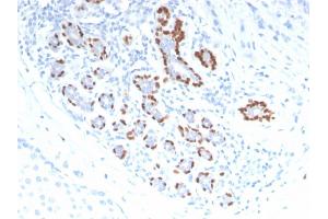 Formalin-fixed, paraffin-embedded human Breast Carcinoma stained with p40 Rabbit Polyclonal Antibody. (p63 Antikörper)