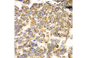 Immunohistochemistry of paraffin-embedded human esophageal cancer using TOMM20 antibody (ABIN5974102) at dilution of 1/100 (40x lens). (TOMM20 Antikörper)