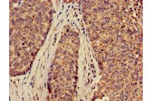 Immunohistochemistry of paraffin-embedded human ovarian cancer using ABIN7170127 at dilution of 1:100 (SLC2A9 Antikörper  (AA 473-511))