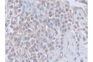 Detection of SNAP23 in Human Prostate cancer Tissue using Polyclonal Antibody to Synaptosomal Associated Protein 23 kDa (SNAP23)