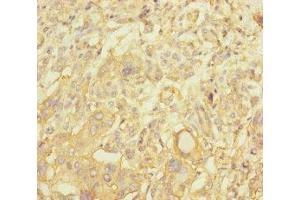 Immunohistochemistry of paraffin-embedded human pancreatic cancer using ABIN7161254 at dilution of 1:100 (NBAS Antikörper  (AA 1-70))