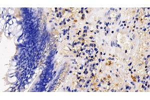 Detection of TMPRSS2 in Human Colorectal cancer Tissue using Polyclonal Antibody to Transmembrane Protease, Serine 2 (TMPRSS2)