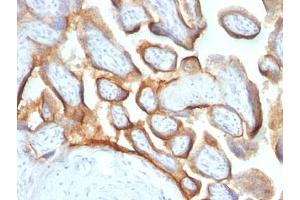 Formalin-fixed, paraffin-embedded human placenta stained with hCG beta antibody (HCGb/54 + HCGb/459). (HCG beta Antikörper)