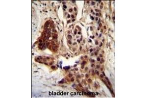 CCD antibody (C-term) (ABIN654810 and ABIN2844484) immunohistochemistry analysis in formalin fixed and paraffin embedded human bladder carcinoma followed by peroxidase conjugation of the secondary antibody and DAB staining. (CCDC122 Antikörper  (C-Term))
