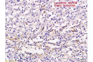 Formalin-fixed and paraffin embedded human liver cancer labeled with Anti ADCY10 Polyclonal Antibody, Unconjugated (ABIN751093) followed by conjugation to the secondary antibody and DAB staining (ADCY10 Antikörper  (AA 1101-1200))