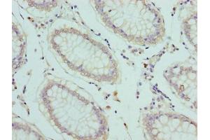 Immunohistochemistry of paraffin-embedded human colon cancer using ABIN7152238 at dilution of 1:100 (SLC1A6 Antikörper  (AA 149-271))