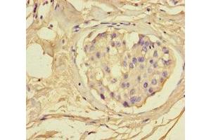 Immunohistochemistry of paraffin-embedded human breast cancer using ABIN7153665 at dilution of 1:100 (Non-Syndromic Hearing Impairment Protein 5 (GSDME) (AA 1-496) Antikörper)