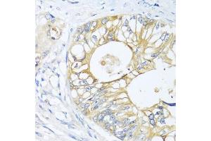 Immunohistochemistry of paraffin-embedded human colon carcinoma using GNAI3 antibody. (GNAI3 Antikörper)