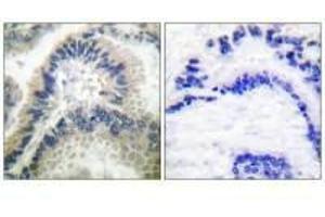 Immunohistochemical analysis of paraffin-embedded human lung carcinoma tissue using Guanylate Cyclase β antibody. (GUCY1B3 Antikörper)