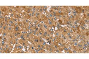Immunohistochemistry of paraffin-embedded Human liver cancer using TRIM34 Polyclonal Antibody at dilution of 1:30