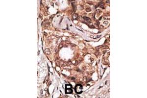 Formalin-fixed and paraffin-embedded human cancer tissue reacted with the primary antibody, which was peroxidase-conjugated to the secondary antibody, followed by DAB staining. (MAGEB2 Antikörper  (N-Term))